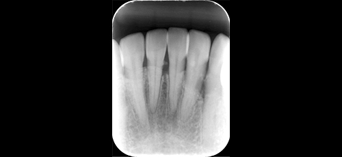軽度の歯周病-2