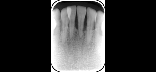 中等度の歯周病-2