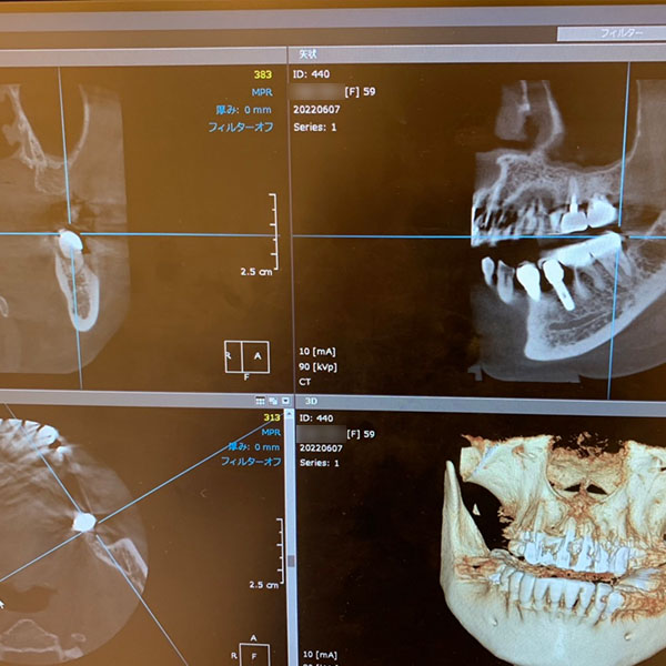 精通した歯科医師がいて実現できる安心なインプラント